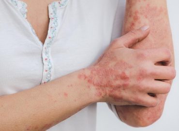 psoriasis-5996424_1280 psoriasis-5996424_1280
