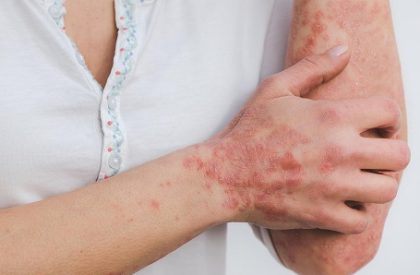 psoriasis-5996424_1280